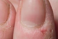 冬天手指周围总是长倒刺 到底是不是缺乏维生素（冬季手指长倒刺是缺乏维生素）