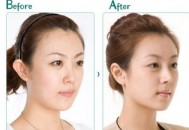 自体软骨隆鼻尖整形手术效果怎样？（自体软骨隆鼻尖整形手术效果怎样啊）