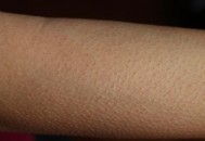 皮肤不平整总起鸡皮疙瘩 教你消鸡皮让皮肤恢复光滑（皮肤鸡皮疙瘩怎么去掉）