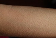 小疙瘩挥之不去的困扰 让皮肤恢复光滑的方法（小疙瘩挥之不去的困扰 让皮肤恢复光滑的方法是什么）