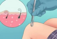 解决“毛发内生”的困扰 下面这些方法可帮你