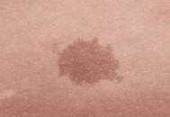 身上长胎记竟暗藏杀机 小心胎记可能是疾病信号（身上长胎记的人命好吗）