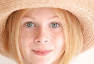 烦人的晒斑因何而来 祛斑首当其冲的就是防晒（晒斑好不好去除）