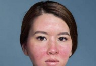 双颊鼻子泛红可能是玫瑰痤疮 皮肤偏白的族群要小心（鼻子发红是玫瑰痤疮吗）