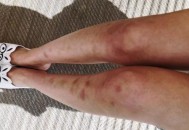 腿上有淤青是否真是被鬼掐的 有些淤青是血液病所致（腿上有淤青是被鬼摸了吗）