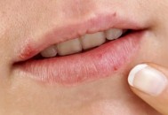 唇部疱疹是病毒性皮肤病 唇部疱疹初期泡内液体增多（唇部疱疹病毒怎么根治）