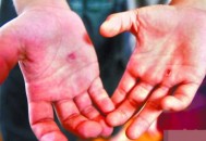 手上长水泡马上去医院 预防汗疱疹时的八大注意细（手上起小水泡汗疱疹用什么方法能好）