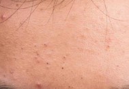 正确处理黑头 弄清楚每个部位长黑头的原因（正确处理黑头 弄清楚每个部位长黑头的原因是）