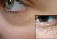 脸上脂肪粒的形成因素 脂肪粒最有效的去除方法